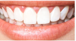 Smile Makeover — Orthodontic & Cosmetic Dentistry — after treatment