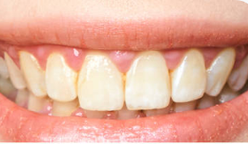 Smile Makeover — Orthodontic & Cosmetic Dentistry — before treatment