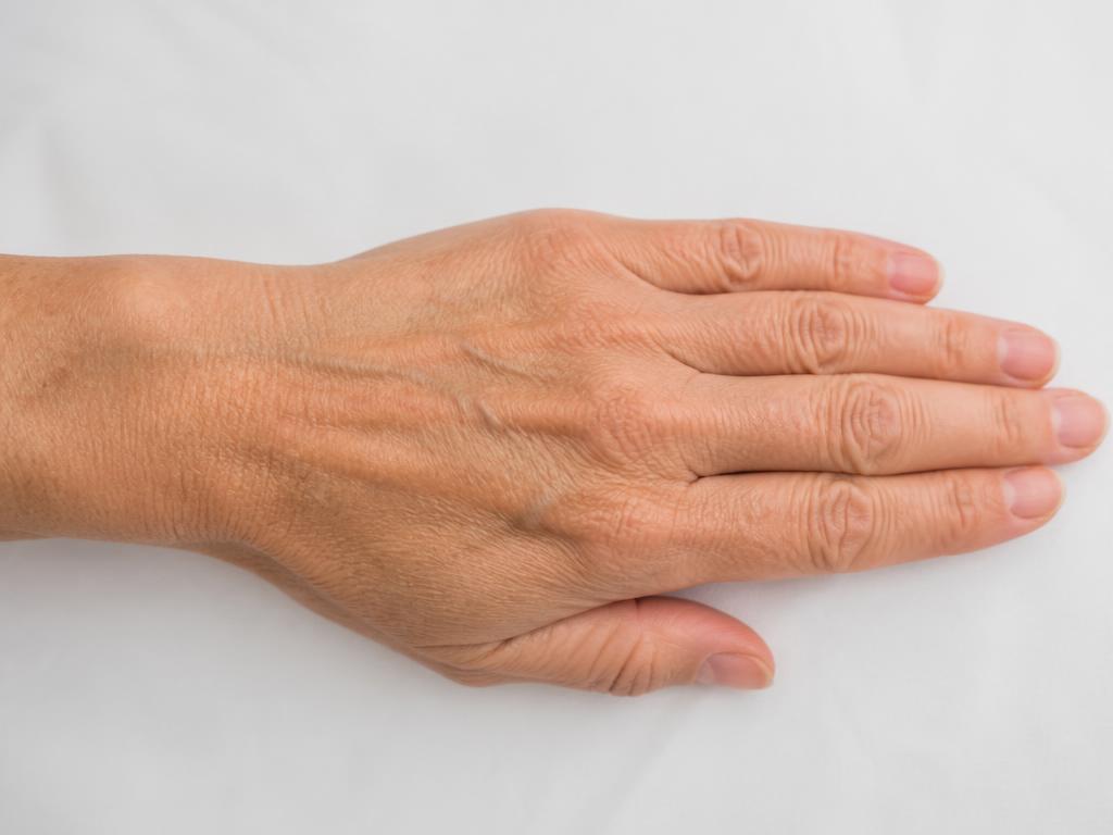 Hand Rejuvenation — Aesthetic Dermatology — before treatment